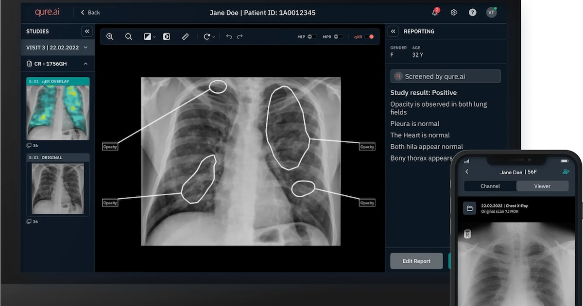 Qure.ai Secures $65M in Series D Funding to Expand Large-Scale AI Operations