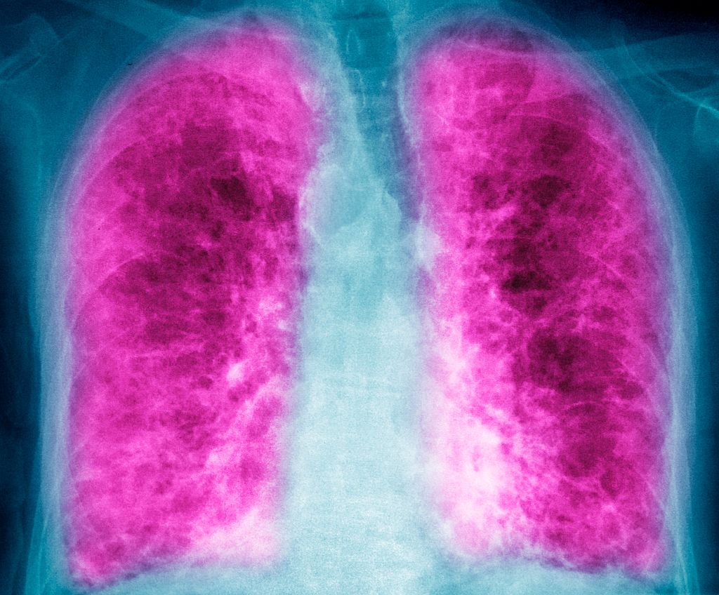 AI-Created Drug Shows Promising Results in Lung Disease Treatment, Though Competitors Lead