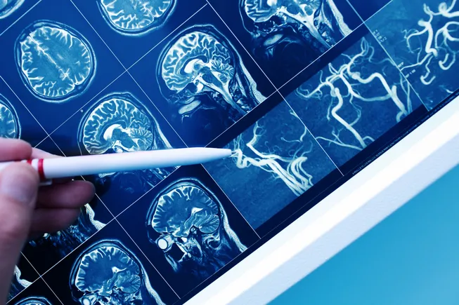 Stryker Acquires Nico, Expands Portfolio with Devices to Remove Brain Tumors and Clots