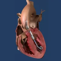 J&J to Pursue FDA Approval Following Successful Trial of Compact Impella Heart Pump