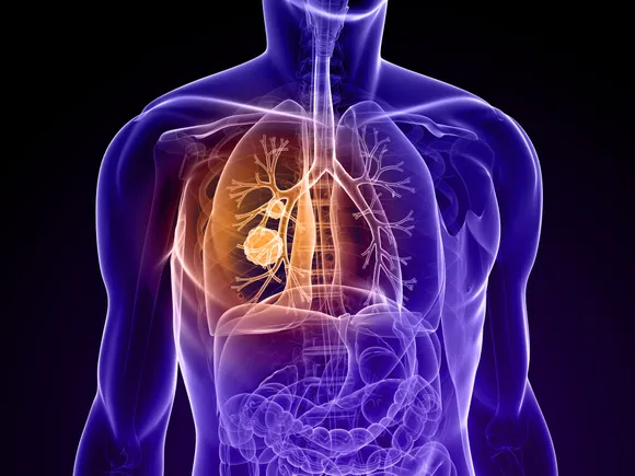 FDA grants Novocure approval for electric field device targeting lung cancer